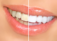 before and after results of teeth whitening Burlington, NC