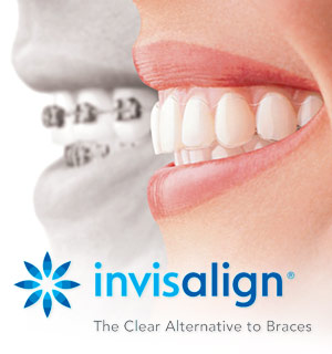 Invisalign logo and side by side images of mouth wearing braces next to mouth wearing Invisalign Burlington, NC